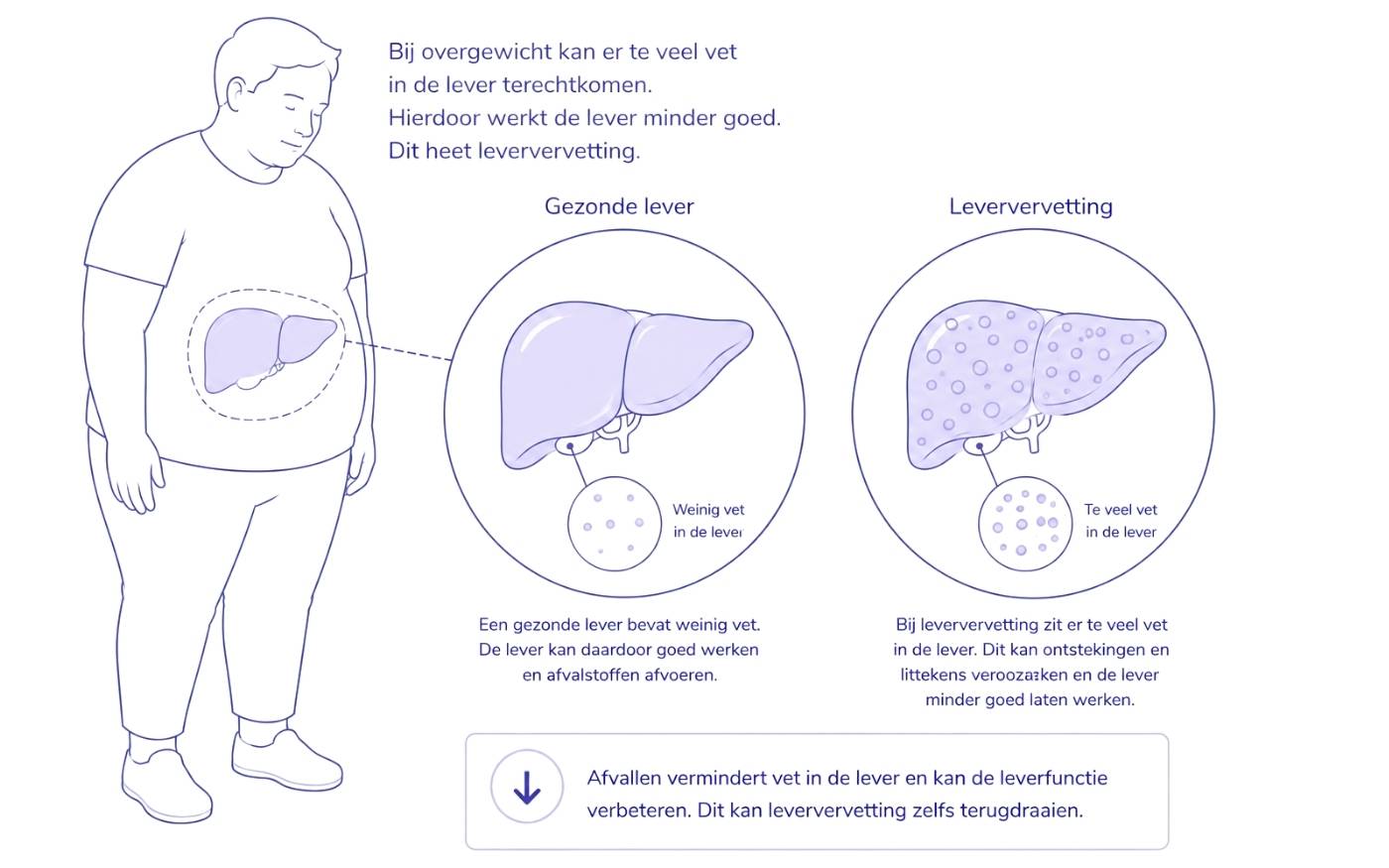 Leververvetting door overgewicht