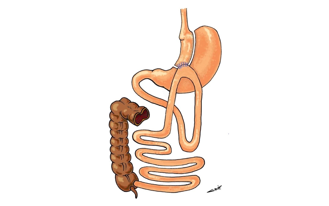 Mini gastric bypass maagverkleining Mini gastric bypass maagverkleining