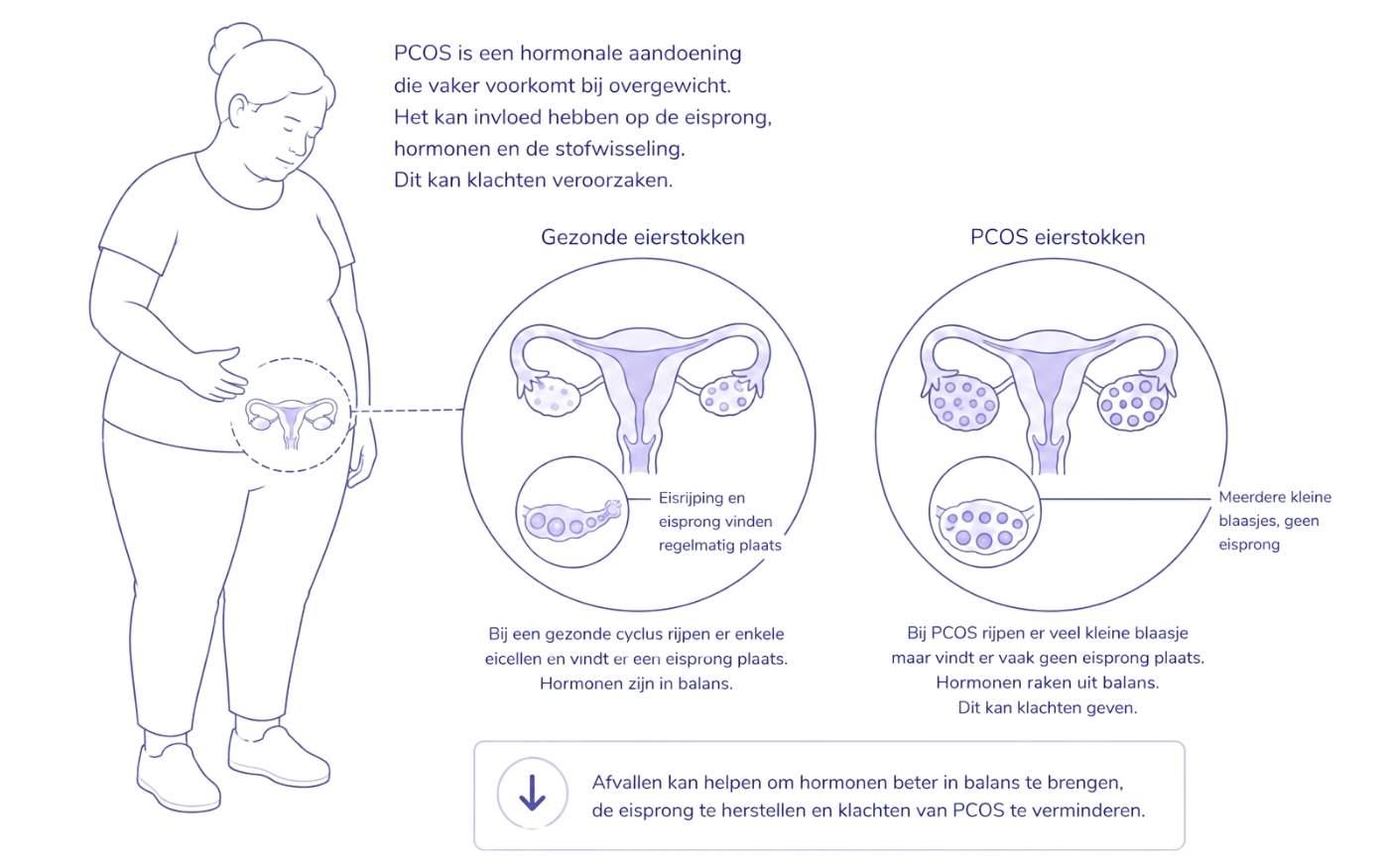 PCOS en overgewicht